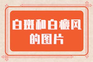 长期的营养不良会不会导致白癫疯,哪些诱因会导致白癜风(是怎么引起的)