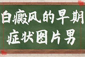 白殿风可以看好吗[诊疗白斑这些是关键]小孩白点癫风可以看好吗