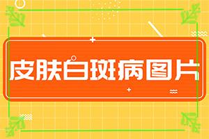 白癜风民间治疗验方药方是什么