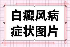 是什么因素造成了人体白癜风